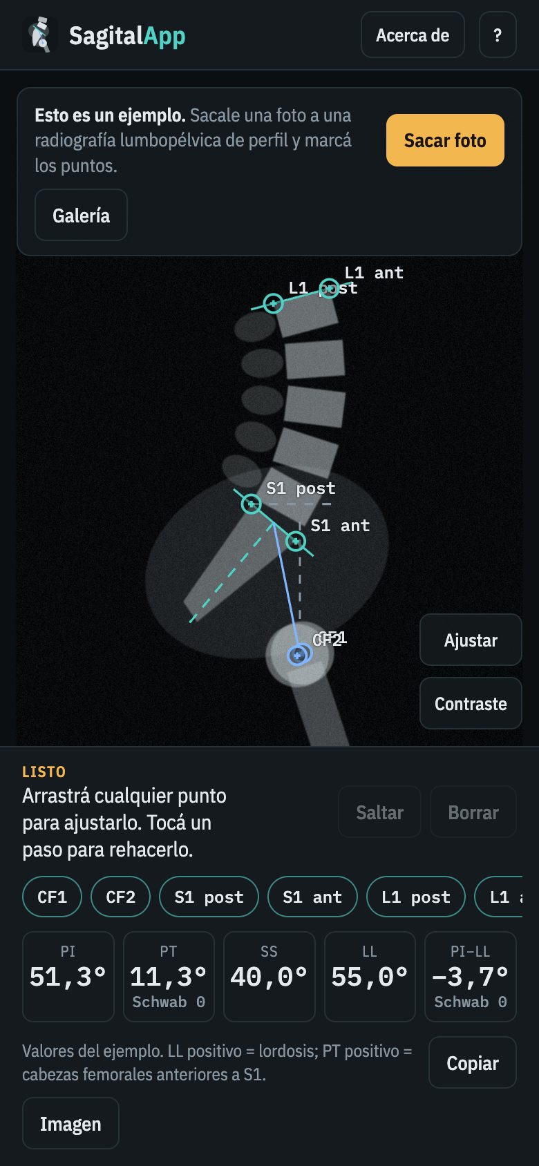 SagitalApp en el celular midiendo PI, PT, SS y LL sobre una radiografía de ejemplo
